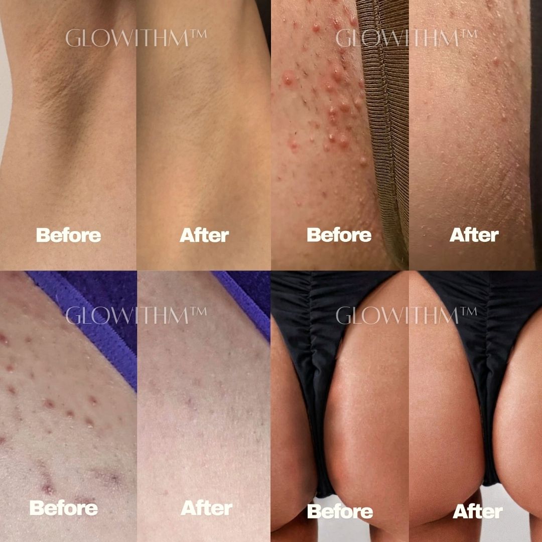 Glowithm™ 4-in-1 Intimate Brightening Light Therapy Pad